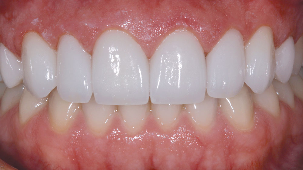 35-year-old male's improved smile on tooth #7