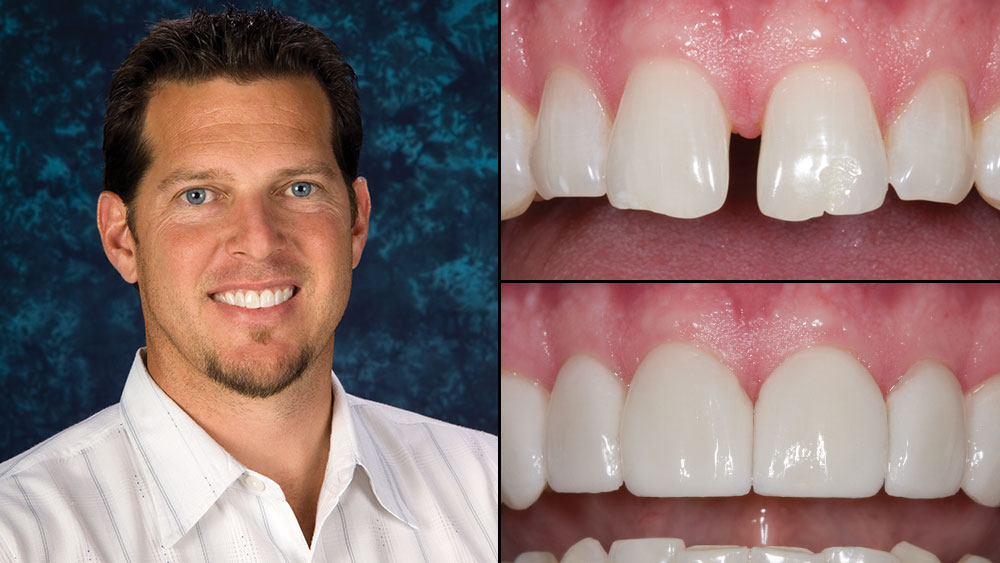 31-year-old male with midline diastema and worn chipped incisal edges