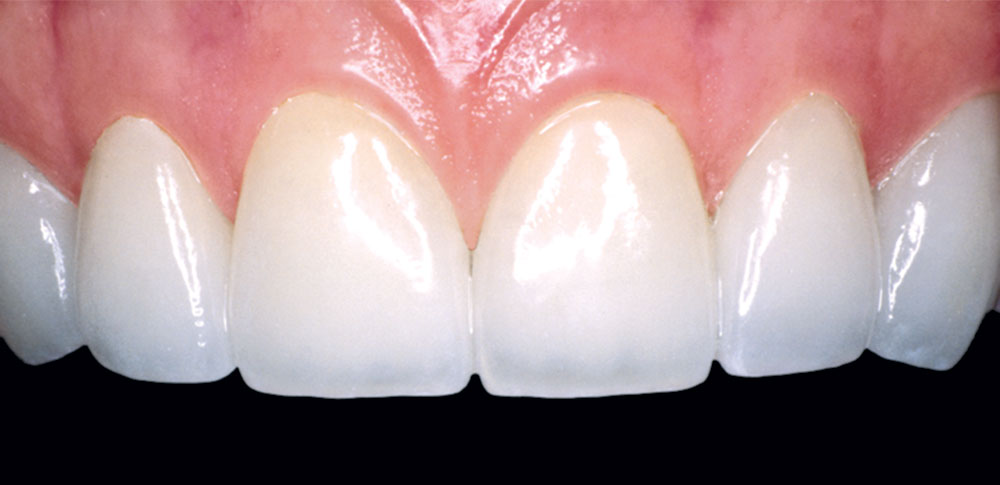 51-year-old female patient's restored smile of tooth #5-12 with IPS Empress veneers