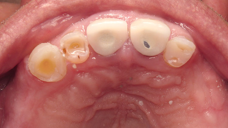 Figure 3: Multiple fractures and tooth loss