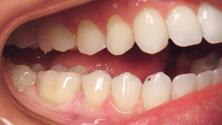 Figure 6: Multiple poorly done Class V restorations