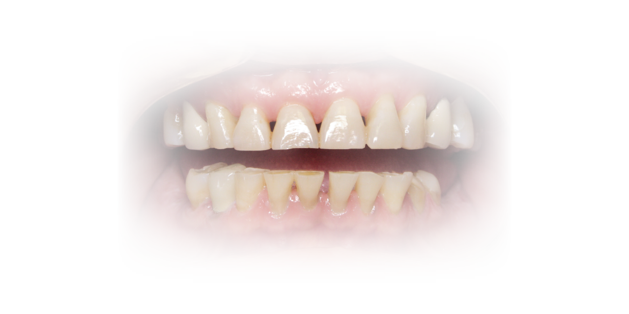 Diagnosing & Educating Patients About Occlusal Disease