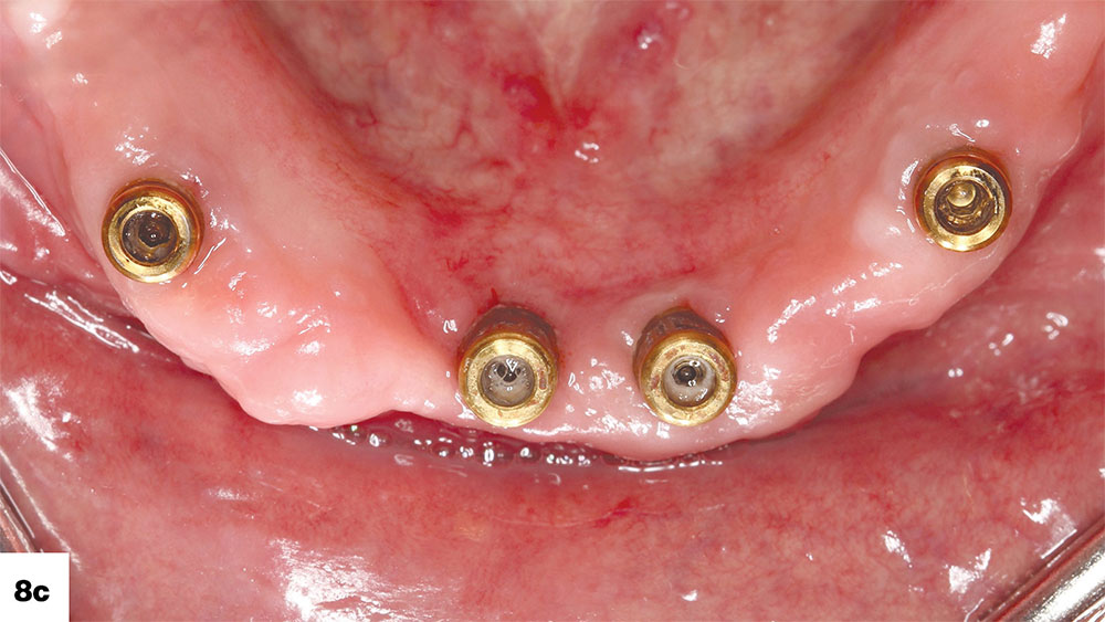 practitioners have the flexibility of placing two implants or more in the edentulous mandible image