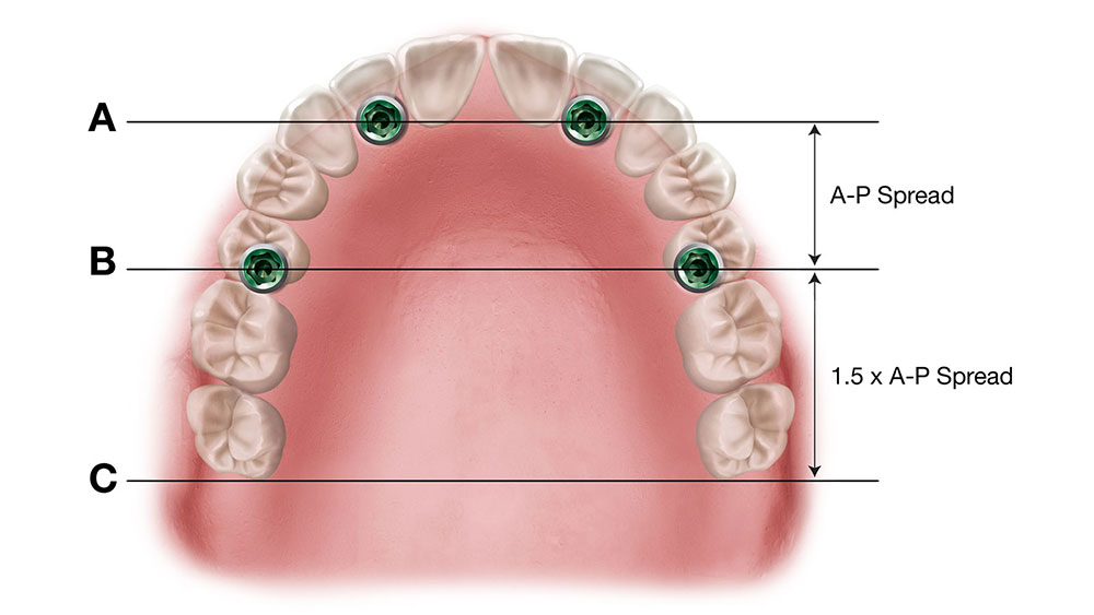 The approximate length of the overdenture’s distal cantilevers can be determined by measuring the A-P spread and multiplying that value by 1.5 image