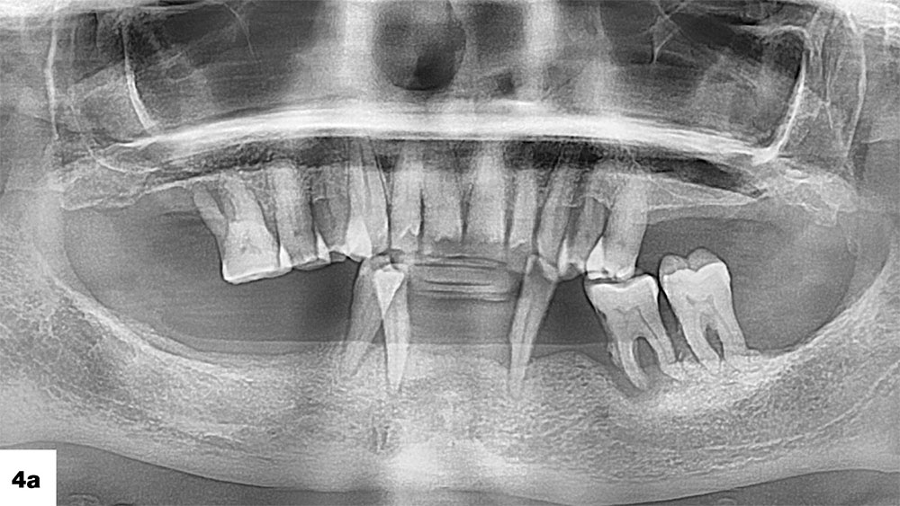 Panoramic radiography was used to assess the vertical bone quantity available to position implants for this patient, who presented with severe periodontal issues and nonrestorable dentition image