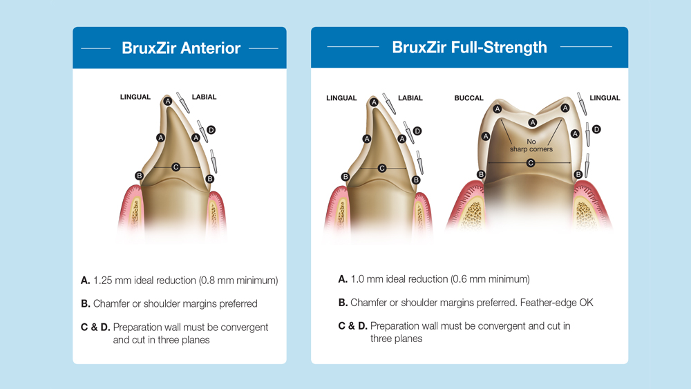 Manufacturer recommendations for Bruxzir Anterior and BruxZir Full-strength
