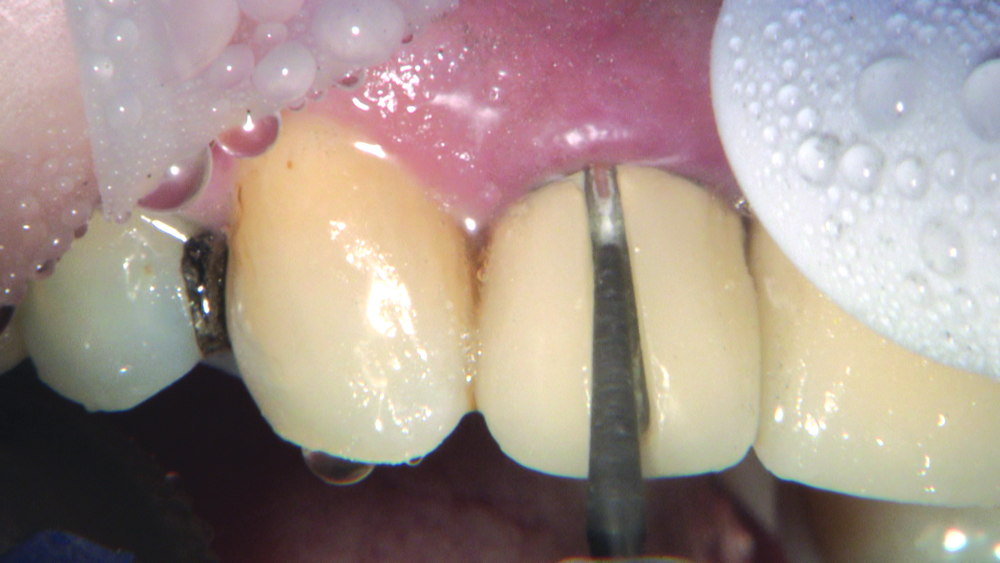 Figure 4: I cut off the crowns by making a vertical opening with a tapered ZIR-CUT™ bur from Kerr Dental (Orange, Calif.) and extend the opening from the gingival margin over the incisal edge and onto the lingual surface. I want to separate the metal all the way to the gingival margin, and care should be taken not to cut the gingiva. I can clearly see the cement interface, so there is less risk of damaging the tooth; to avoid damage to the gingiva, a retraction instrument can be used to protect the soft tissue.