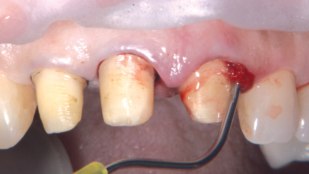 Figure 8: These margins were already more subgingival than I prefer, so I did not drop the margin further. The gingival laceration on tooth #9 will be addressed with laser treatment.