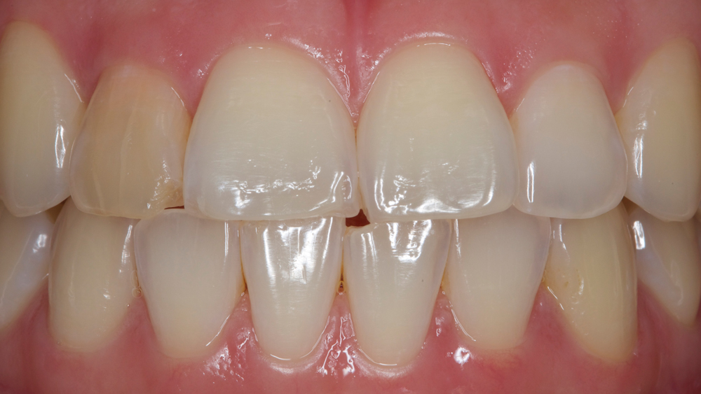 picture showing preoperative conditionof patients teeth