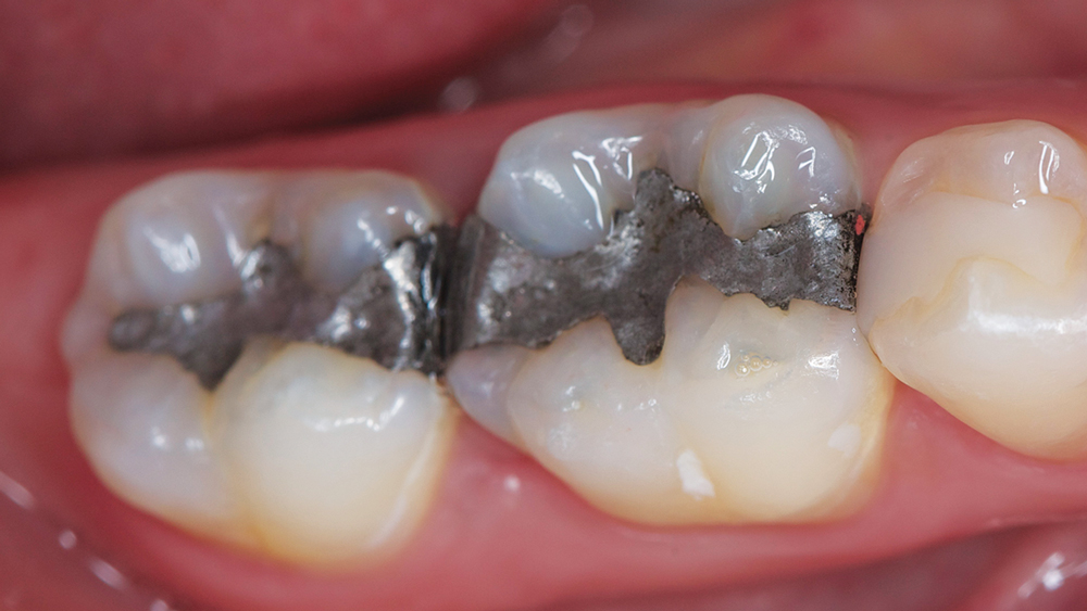 Figures 1a: Preoperative view of tooth #30 and #31.