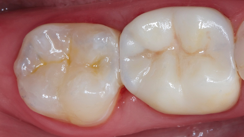 Figures 14a: Camouflage composite was used alongside a BruxZir NOW crown to create an esthetic result with a fully in-office workflow.