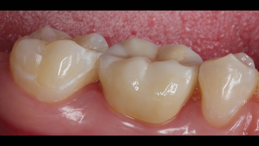 Figures 14b: Camouflage composite was used alongside a BruxZir NOW crown to create an esthetic result with a fully in-office workflow.