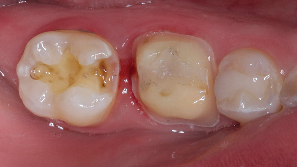 Figures 10b: While the BruxZir NOW crown was being milled, the amalgam on #31 was removed.