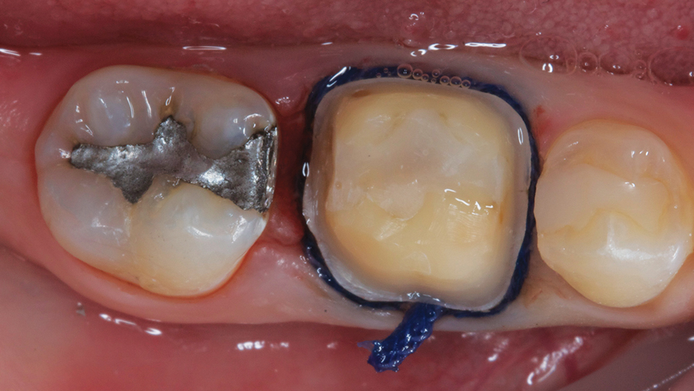 Figure 2: Prior to taking the digital impression, tooth #30 was reduced by 1.5 mm and cord was placed.