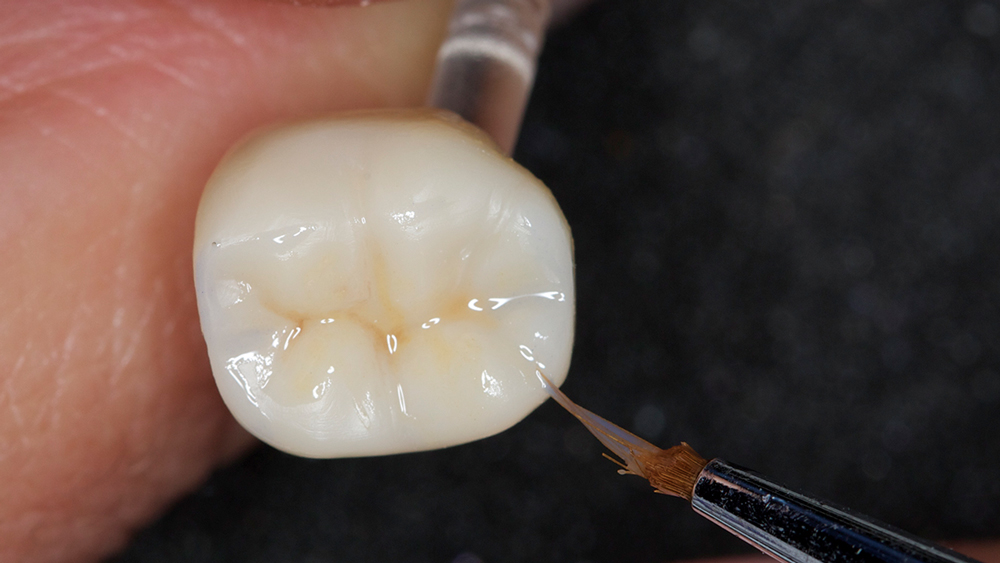 Figure 12: Occlusal stain was placed in the grooves of the BruxZir NOW crown.