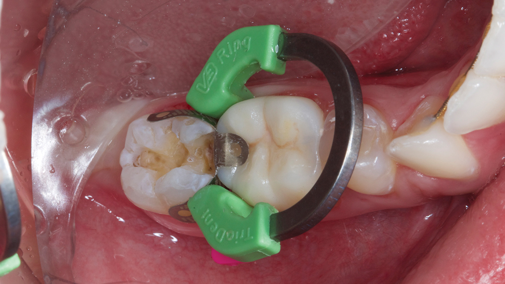 Figure 13: Isolation for the composite on #31 was achieved by using the Isolite Illuminated Dental Isolation System alongside the Triodent V3 Sectional Matrix System.