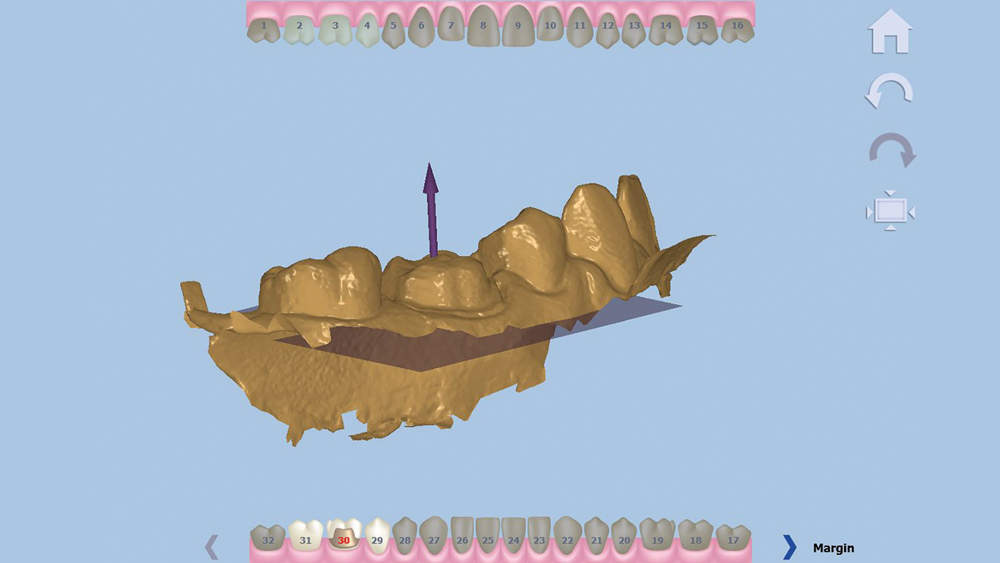 Figure 3: The design software asks the user to indicate the direction of the occlusal.