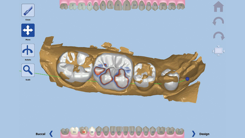 Figure 6: The software generates an anatomical crown design over the prepared area.