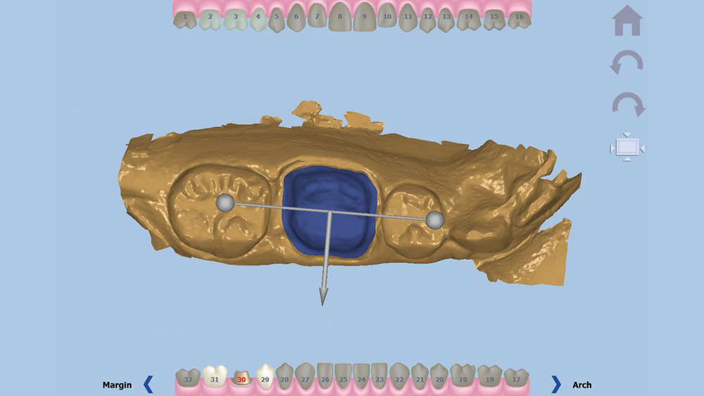 Figure 5: With the occlusal direction and margin confirmed, the user indicates the buccal direction.