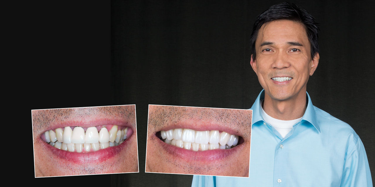 Man smiling as a result of using monolithic zirconia