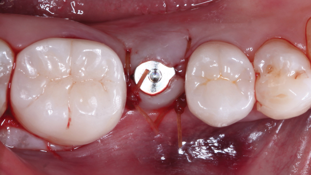 A screw-retained implant added