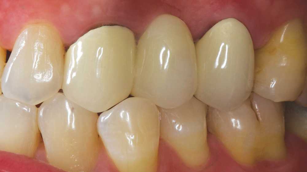 Preoperative Condition Image 1 - Side view of teeth