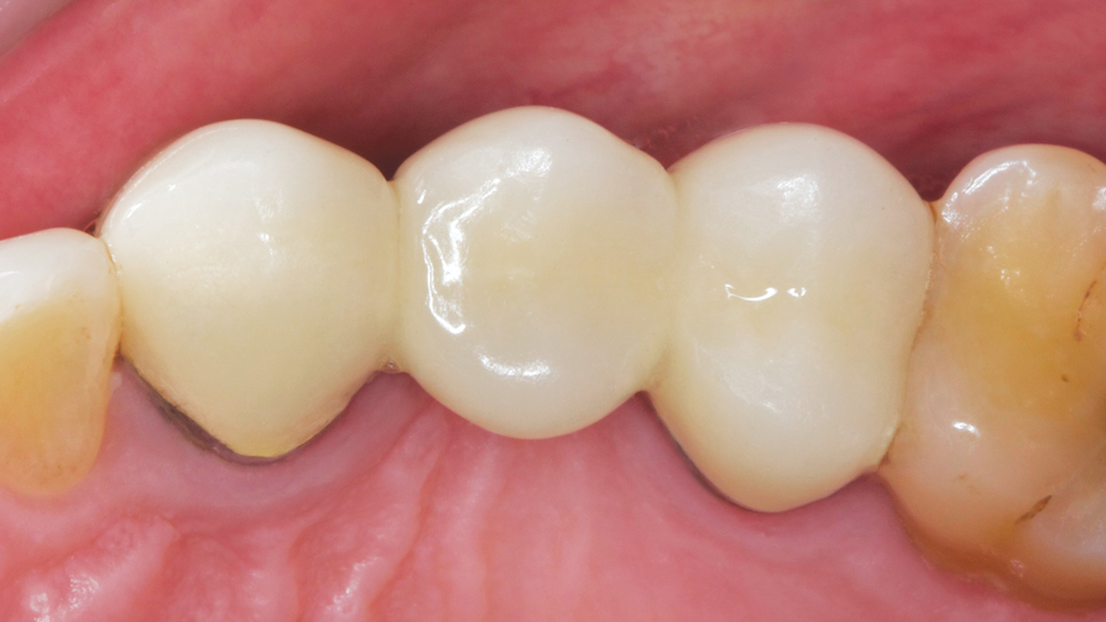 Preoperative Condition Image 2 - Top view of teeth
