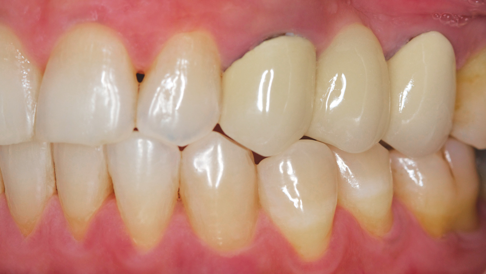 During Treatment Image 1 - Side view of teeth