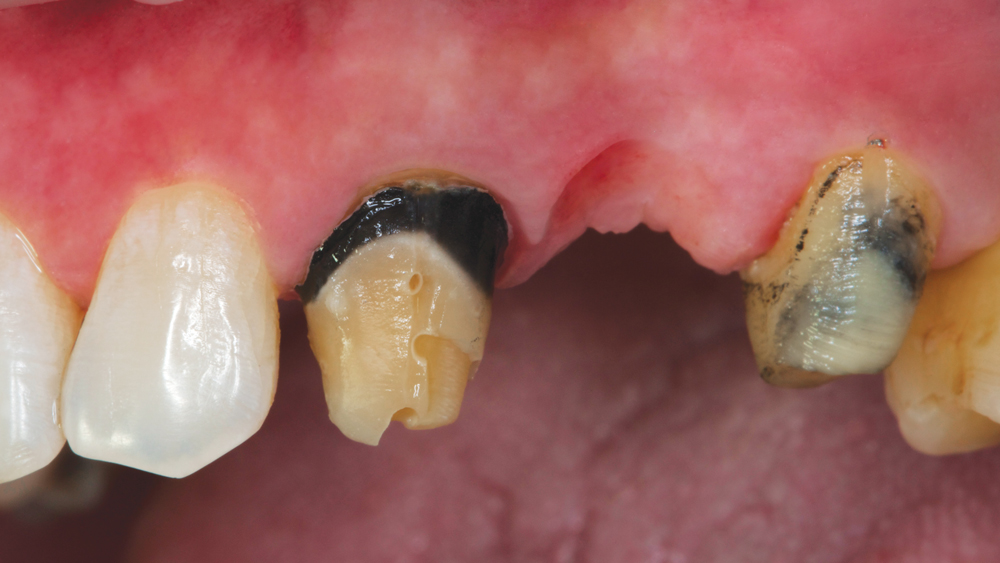 During Treatment Image 2 - Side view of teeth removed