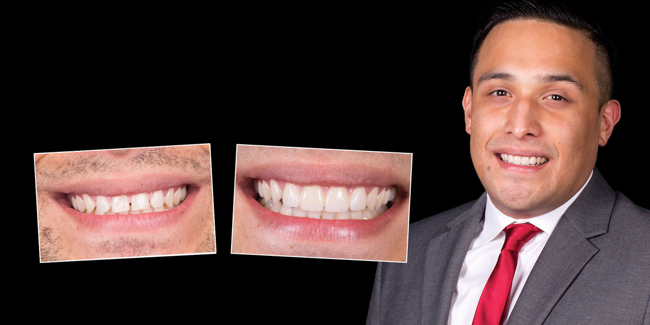Confidence in Veneers: Choosing the Right Material to Eliminate Spaces and Outlast Clenching