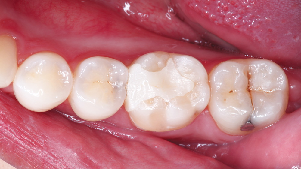 Patient's teeth #19 and #20 pre-op