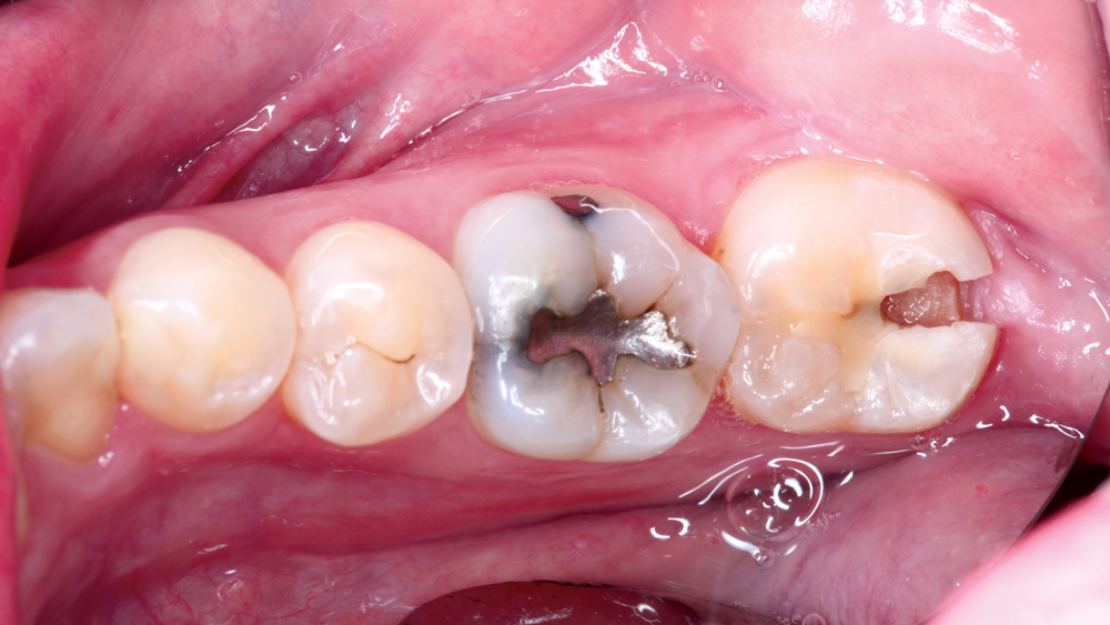 Patient's tooth #31 during pre-op