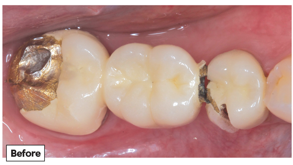 Before photo of patient's posterior PFM crowns chipping and fracturing after three years