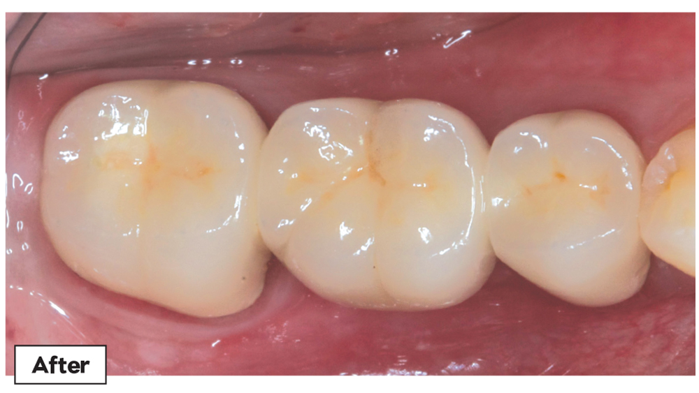 After photo of patient's restored teeth with a 3-unit Obsidian Fused to Metal bridge
