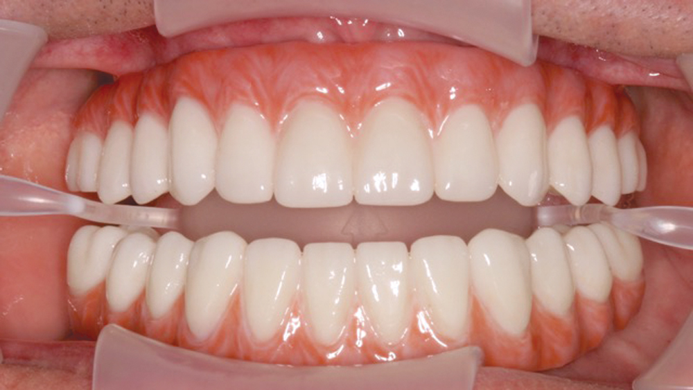 Overhead shot of patient's teeth after final restorations