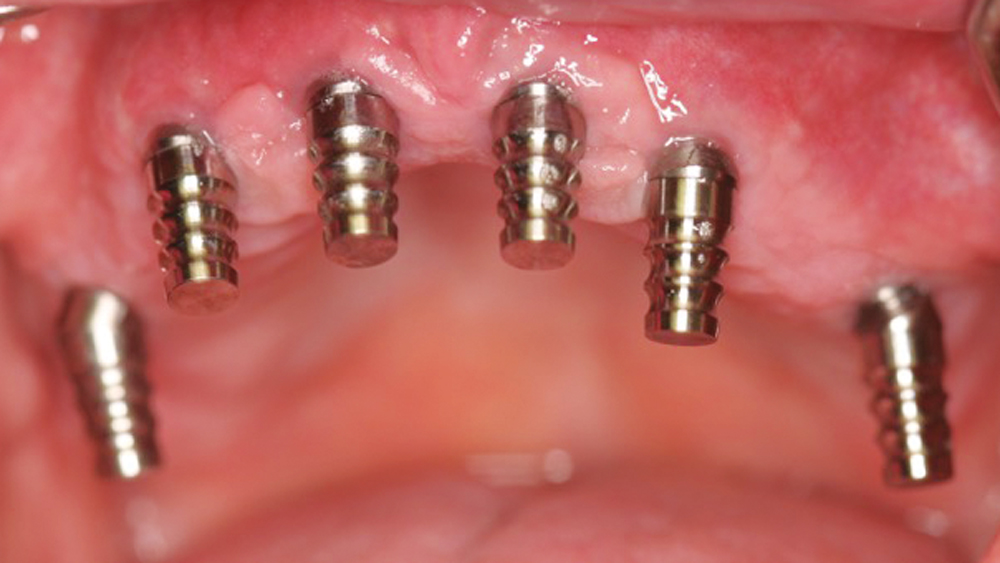 After four months of healing, initial impressions were taken so the arches could be restored following a straightforward protocol similar to that of the traditional screw-retained acrylic hybrid denture