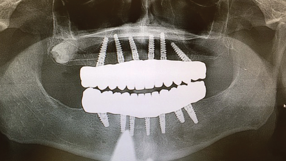 Radiographic view of patient's teeth after final restorations