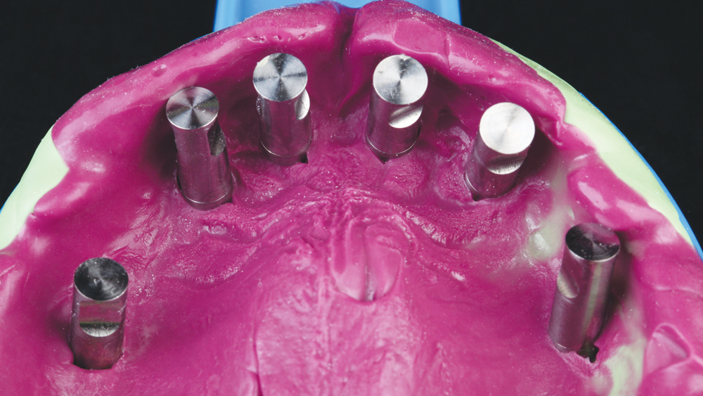 screw-retained acrylic hybrid denture