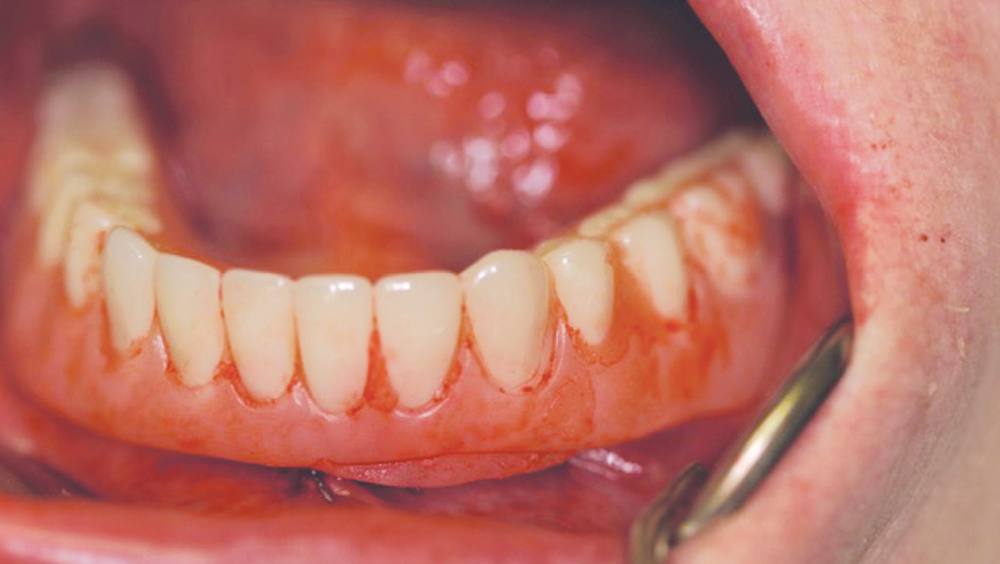 Immediate dentures were soft-relined to seat over the healing abutments