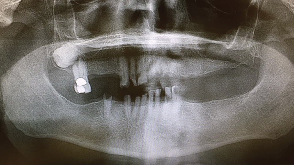 X-ray view of the patient's missing teeth and dentition
