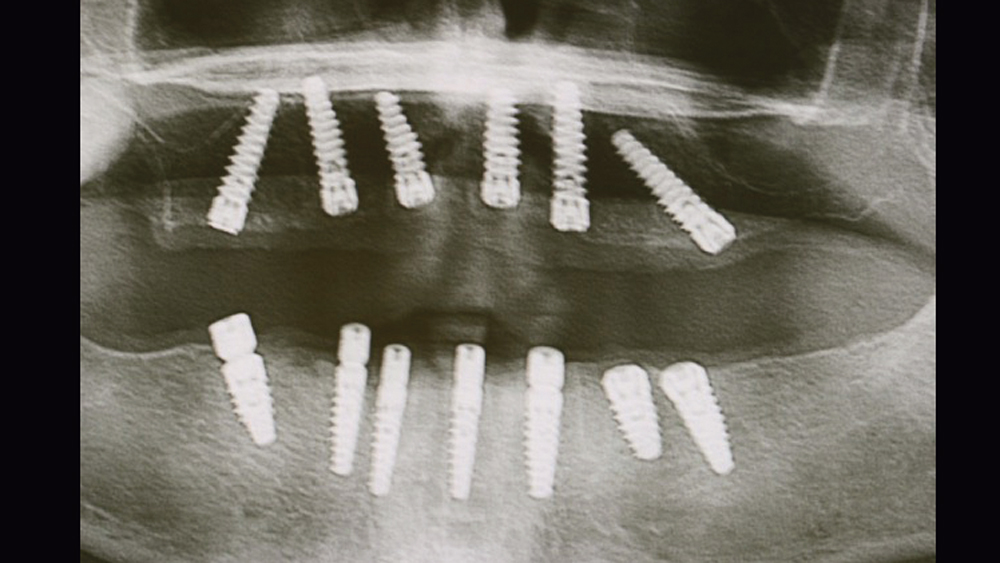  Panoramic radiographic view of implants in final position
