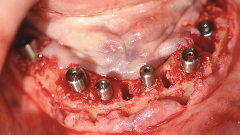 Because high primary stability of 45 Ncm was achieved for each implant, healing abutments were placed