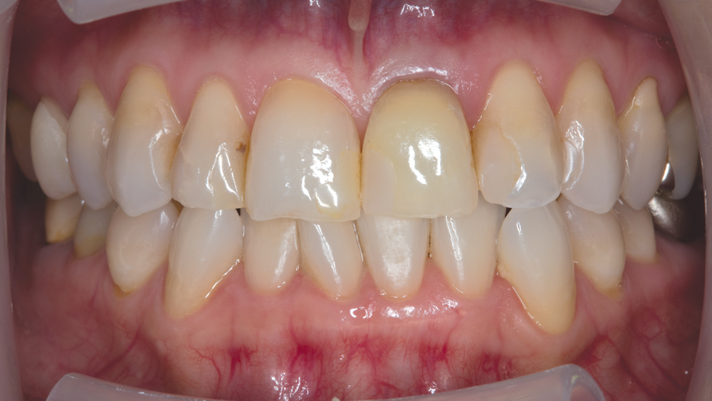 Patient's teeth with unpleasant maxillary dentition 