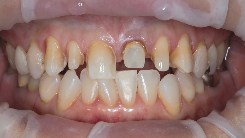 Patient's maxillary dentition
