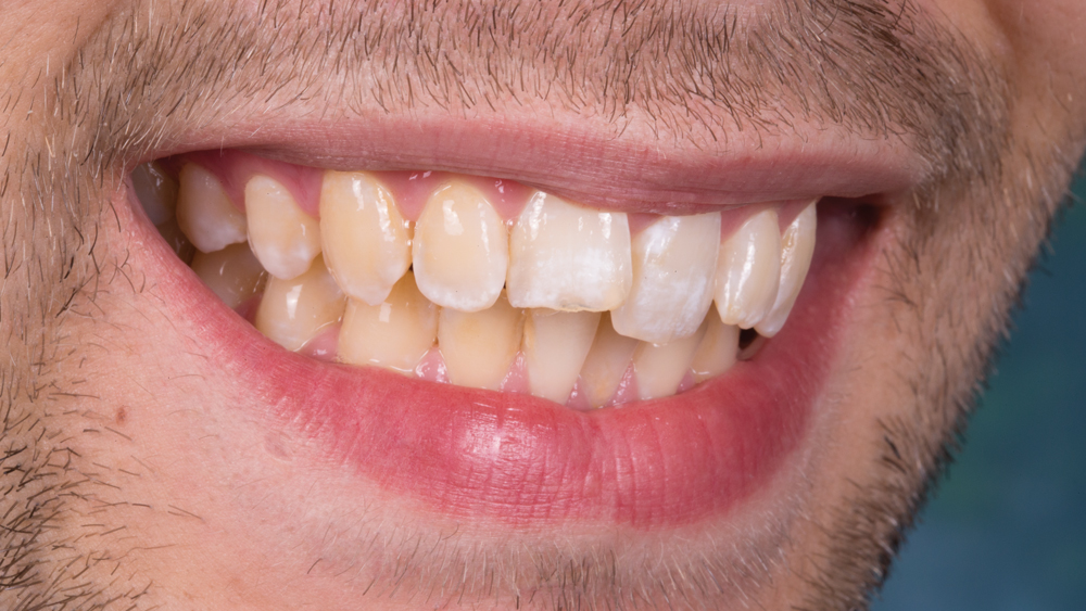 Patient with misalignment and minor cracks on his maxillary anterior teeth