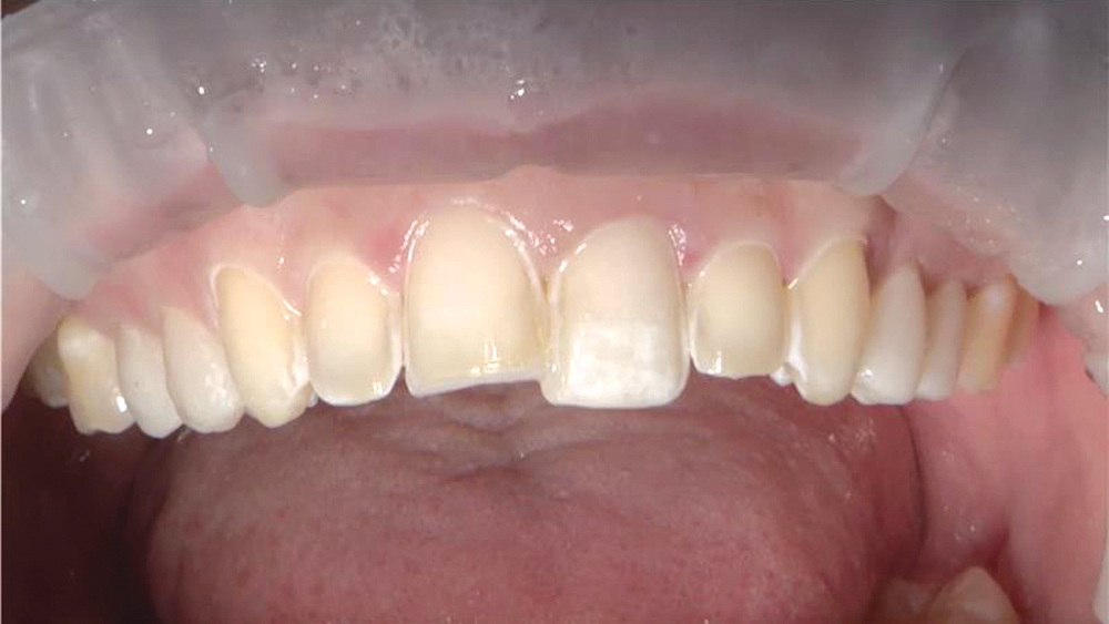 Patient's teeth during restoration procedure for teeth #4–13