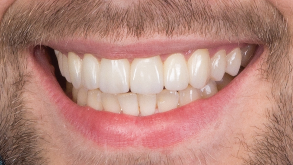 Patient after photo smile with improved color, alignment and esthetics of his anterior teeth