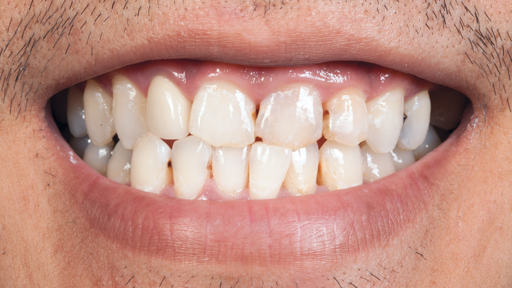 Patient's teeth before photo of teeth #7–10 exhibiting chipping along the incisal edges and loss of vertical dimension