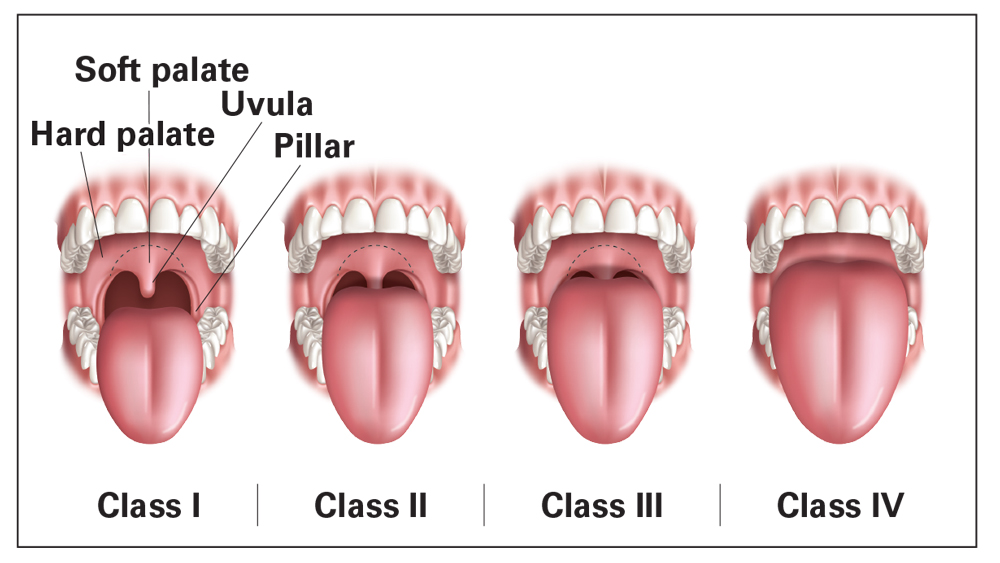 Mallampati scale is used to determine how obstructed or unobstructed the airway is by visual assessment