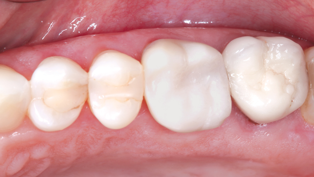 View of teeth restored (top-view)